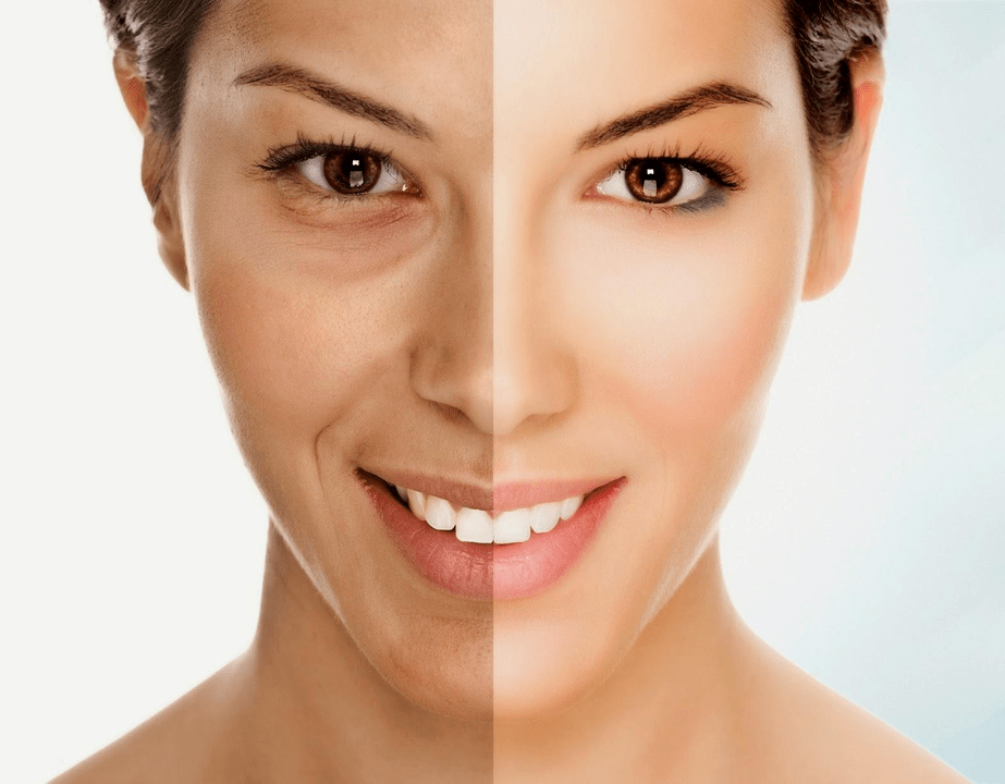 Intenskin pour le rajeunissement du visage