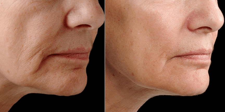Rajeunissement fractionnaire laser - effet