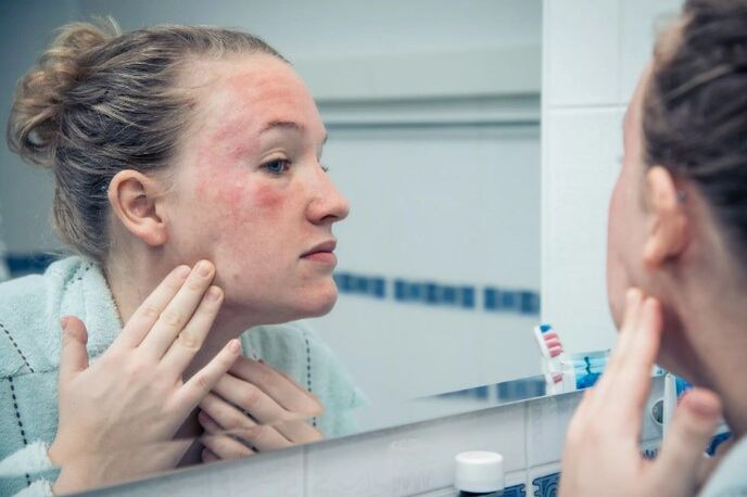 Maladies chroniques de la peau dans la phase d'aggravation