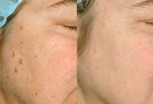 Élimination de la pigmentation sur la peau