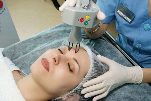 Rajeunissement au laser